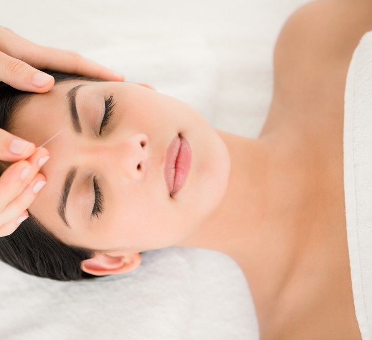 6 Surprising Benefits of Acupuncture