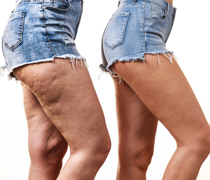 Everything You Need to Know About Getting Rid of Cellulite