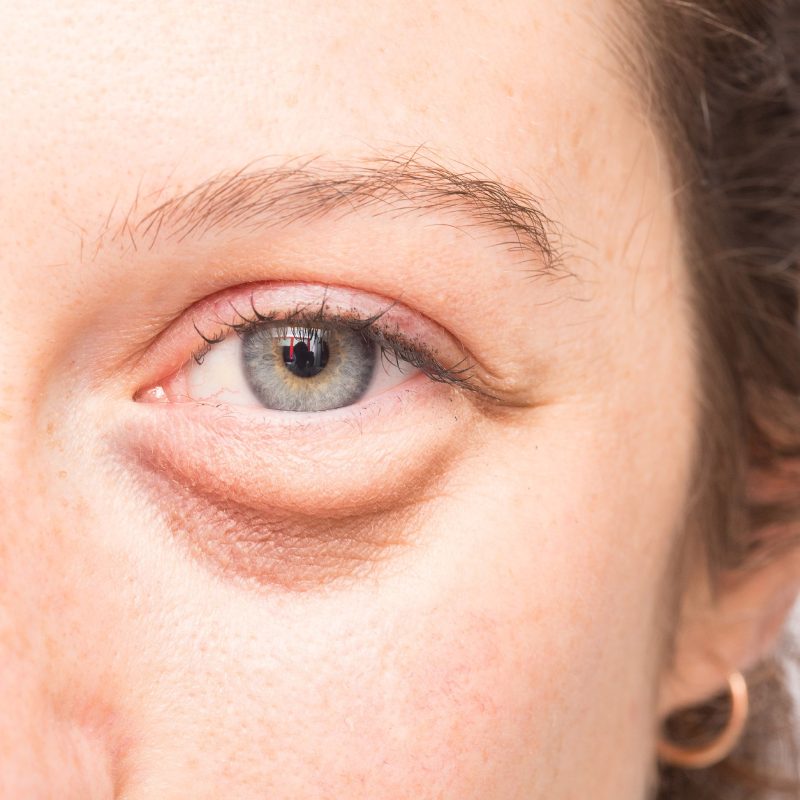 7 Things That Can Cause Under Eye Puffiness and Dark Circles